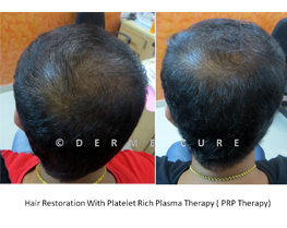 Hair Loss Treatment