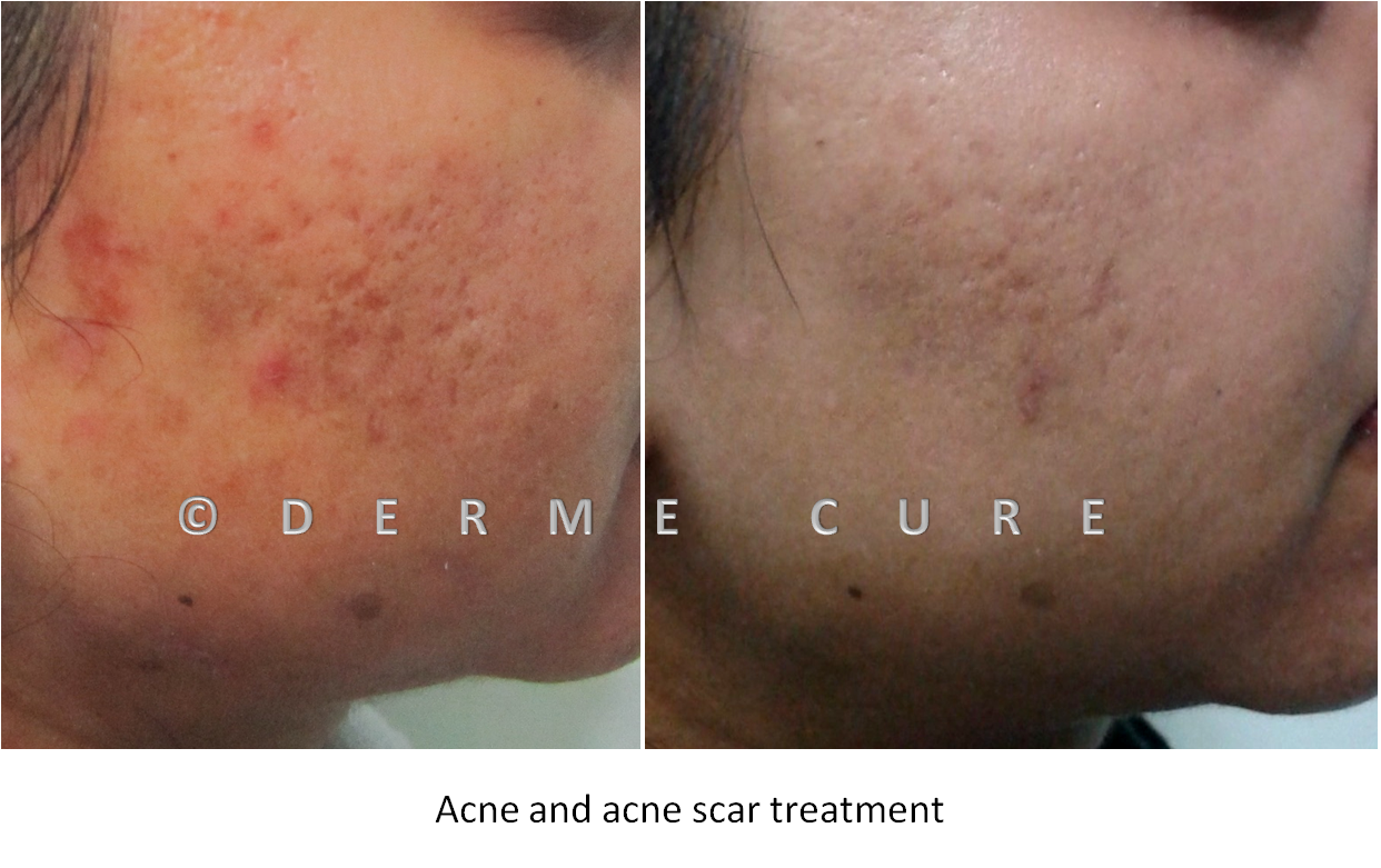 Acne Scar Treatment