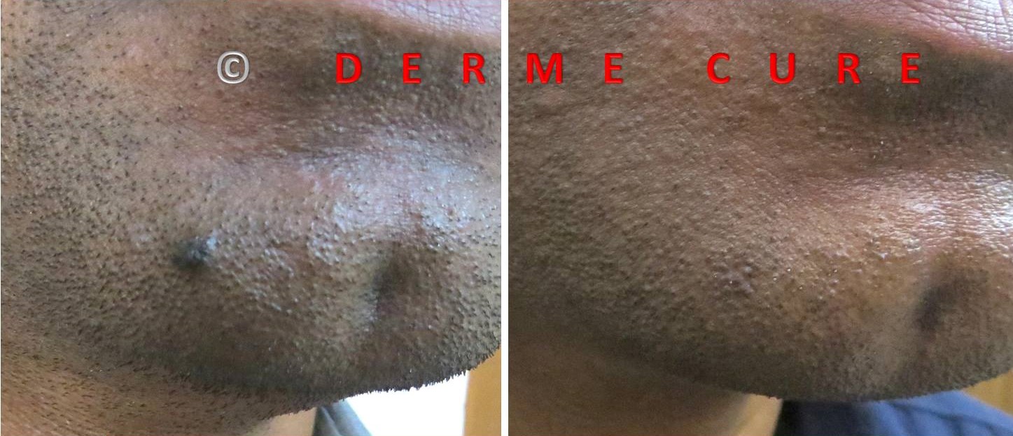 Laser Mole Removal